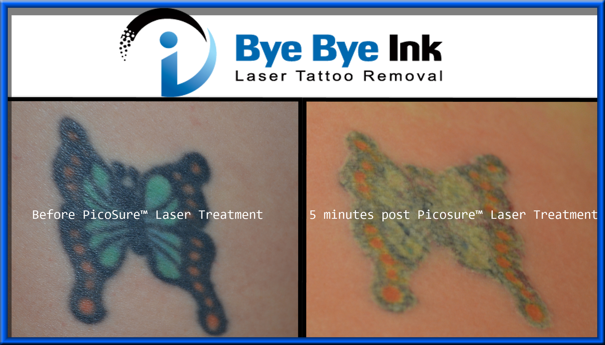 Before and after one PicoSure™ Laser tattoo removal treatment ...