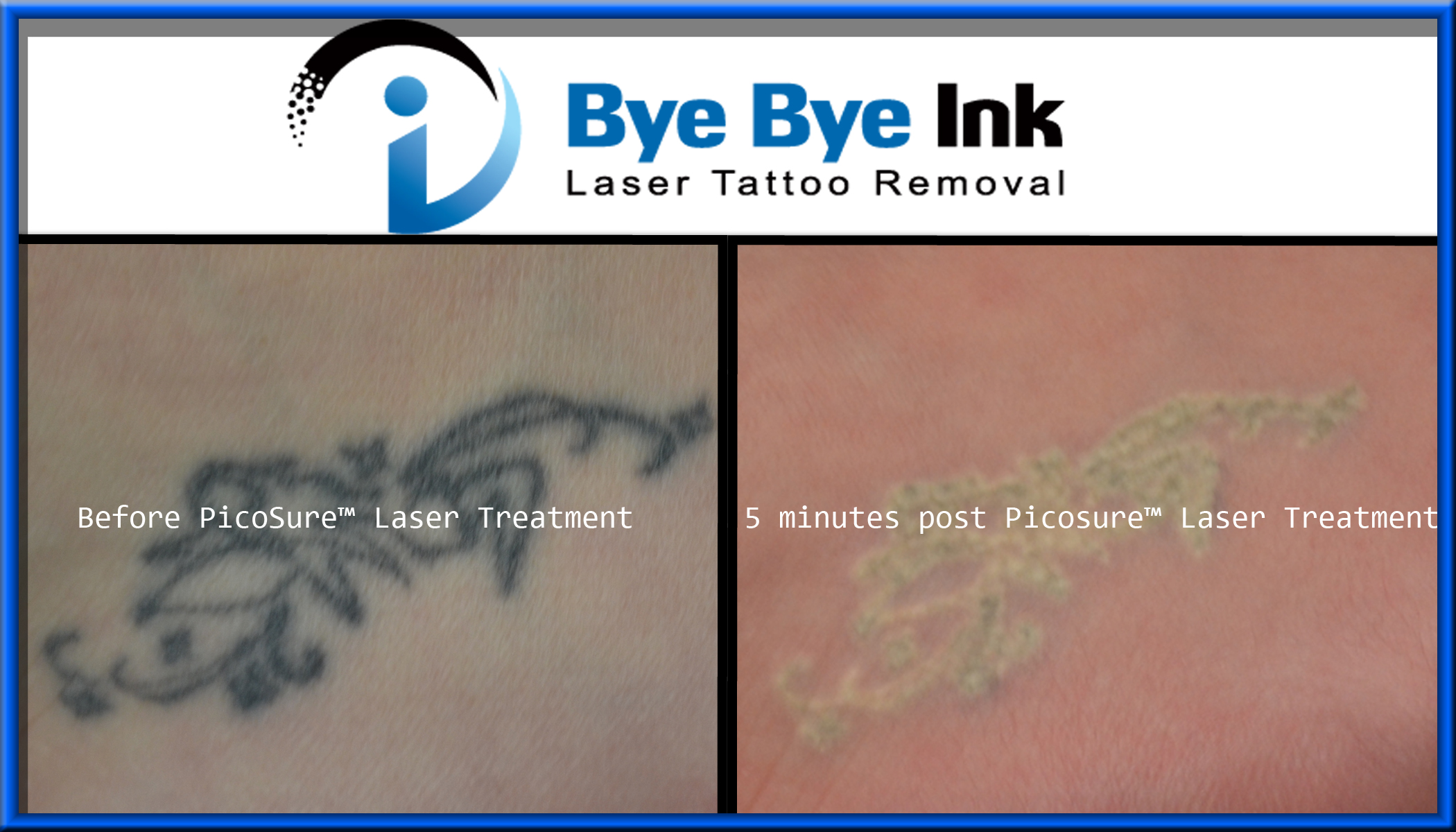 ... and after one PicoSure™ Laser tattoo removal treatment | pureluxespa
